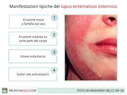 Con i farmaci di ultima generazione si riducono gli effetti collaterali e i tassi di ospedalizzazione dei. Lupus Eritematoso Sistemico Cause Sintomi Diagnosi E Terapia Della Mattia Autoimmune