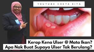 Rawatan ulser amat mujarab sekarang. Cara Hilangkan Ulser Mulut Dengan Cepat