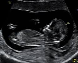 When it's time for your scan you'll go into a fairly darkened room, where you'll meet the person who will do the. Ultrasound Verloskundigenpraktijk Vondelpark