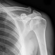 Image result for Shoulder XRay