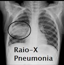 A pneumonia eosinoffii~a aguda (pea) e uma doe~ rara, de etiologia desconhecida, caracterizada por eosinofilia pulmonar marcada, geralmente niio associada a aumento dos eosinofilos no sangue. Pneumonia Pediatriavirtual Com