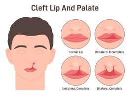 Image result for Cleft Lip