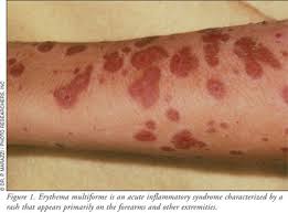 Cutaneous Adverse Reactions Stevens Johnson Syndrome