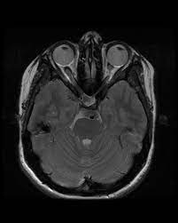 Morning Glory Syndrome Radiology Case Radiopaedia Org