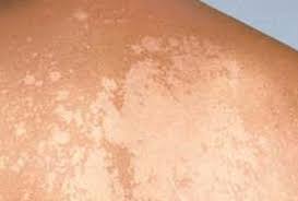 Pesendorfer sind ihre hautärzte und dermatologen für alle fragen rund um die haut in wien. Pityriasis Versicolor Beim Menschen Was Ist Diese Heimtuckische Krankheit Wie Man Tinea Versicolor Mit Salbe Auf Der Haut Von Gesicht Korper Kopf Oder Extremitaten Heilt Von Dem Was Erscheint Und Wie