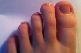 Hygiene und sauberkeit stehen an erster stelle! Fussnagel Verformt Nagelkrankheiten