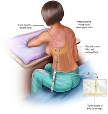 Image result for Thoracentesis