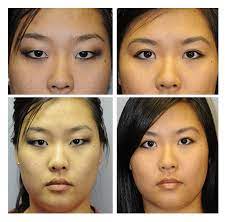 Asian eyelid surgery can be combined with a brow lift for patients with concerns about a drooping brow or wrinkled . Facial Surgery Before After Gallery Denver Fante Eye Face Centre