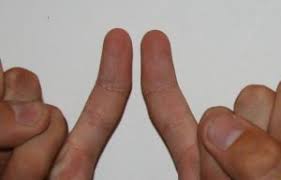 Some disorders, such as rheumatoid arthritis, and injuries can cause the fingers to bend abnormally. A Bent Pinky Finger Is Genetic Bent Little Finger Genetics Finger