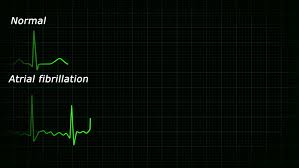 Atrial Fibrillation Ecg Loopable Stock Footage Video 100 Royalty Free 1223791 Shutterstock