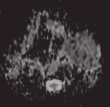 Image result for Necrotizing Otitis Externa