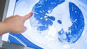 Coyotes are taking steps toward a normal fall term campus updates & information. Coronavirus Was Covid 19 In Der Lunge Anrichtet Der Spiegel