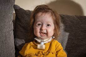 Toddler Has World S Only Case Of Benjamin Button Like Disease