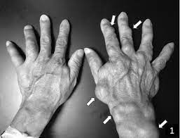 Maffucci Syndrome The Journal Of Rheumatology