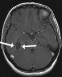 Klinik Und Poliklinik Fuer Neurochirurgie Gliome