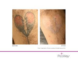 Red diamond laser tattoo removal. Picoway Tattoo Removal Nuderma Health And Medical Spa