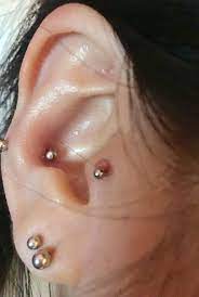 Most Likely A Keloid Caused By Curved Barbell Piercing