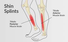 But for the majority it's just a real nuisance. Shin Splints Orchard Health Clinic