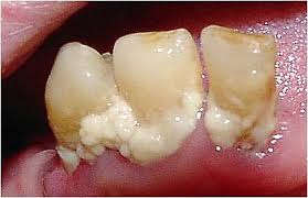 Dental plaque - Wikipedia