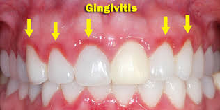 Image result for Gingivitis
