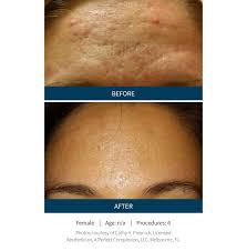 Redlands aesthetic skin care is located at 124 e olive ave, redlands 92373, united states. Microneedling Prp Natural Elegance Beauty