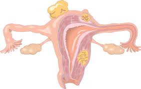 A symptom, such as pain or fatigue, is felt or noticed by the person who has it.; Womb Cancer What Are The Early Signs And Symptoms Of Womb Cancer Patient Talk
