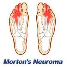Morton S Neuroma Is The Swelling Of Nerve Tissue In The Forefoot Or Ball Of The Foot Which Can Cause Sev Pijn In De Voet Het Menselijk Lichaam Voetverzorging