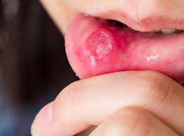 Cures For Canker Sores Archer Dental