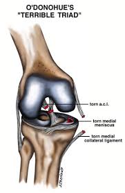 Discover how to treat and recover from a torn anterior cruciate ligament (acl). Acl Tears Pinnacle Orthopaedics