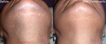 But the average results you can expect is. Laser Ipl Hair Removal Medway Kent Purelite Non Surgical Aesthetics