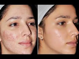 Homemade acne face masks are very effective at helping to treat and prevent acne outbreaks. 15 Diy Face Masks For Acne Scars Find The Latest Online Hints