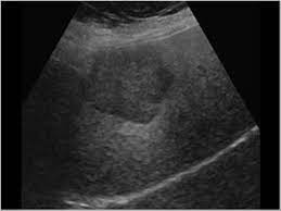Hiperplasia Nodular Focal Lesion Focal Hiperecogenica