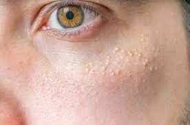 We did not find results for: Milia Under Eyes Causes Diagnosis And Treatment