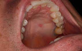 Homepimplesmouth pimplespimple inside mouth roof, around, corner of mouth causes, treatment. Bump On Roof Of Mouth Definition Symptoms Causes Treatment And More Ricearch Com