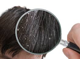 Ancient Cure For Dandruff Revealed But Would You Ditch Shampoo For The Medieval Remedy