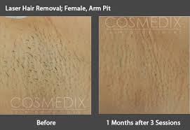 But the hair removal results last longer than 6 months and take a lot lesser time when doing another treatment. Laser Hair Removal Specialists In Sydney Cosmedix Clinics