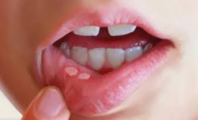 Alcohol is associated with an increased risk of mouth cancer. Know Symptoms Of Mouth Cancer And How To Treat It Newstrack English 1