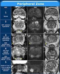 The Radiology Assistant Prostate Cancer Pi Rads V2