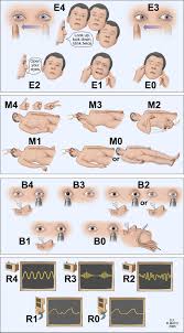 Image result for Coma Exam