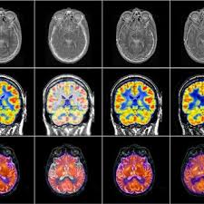 Image result for AIDS Dementia Complex