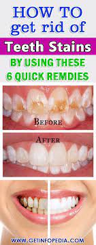 Home Remedies To Get Rid Of Teeth Stains How To Get Strong Teeth Getinfopedia Com Stained Teeth Teeth Remedies Discolored Teeth