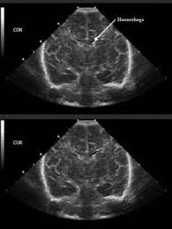 Periventricular Hemorrhage Intraventricular Hemorrhage Background Pathophysiology Epidemiology Ultrasound Ultrasound Tech Ultrasound Technician