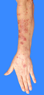 We did not find results for: Autoimmunkrankheiten Umm Universitatsmedizin Mannheim