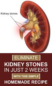 Home Remedy To Eliminate Kidney Stones In Just Two Weeks Medical First Aid Kidney Health Kidney Detox Cleanse Kidney Stones