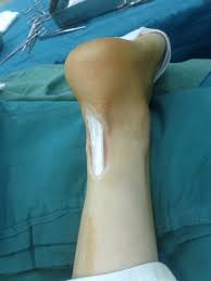 Achilles tendon injuries are common especially in individuals who are physically active. Achilles Tendon Rupture Medicine Anatomy Injury Operation Leg Hospital Human Body Part Pxfuel