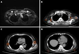 We'll show you breast cancer pictures to help you identify any physical traits of the condition. Primary Breast Cancer Patient With Poliomyelitis A Case Report
