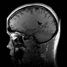 Magnetic resonance imaging (mri) of the body uses a powerful magnetic field, radio waves and a computer to produce detailed pictures of the inside of. Magnetic Resonance Imaging Wikipedia