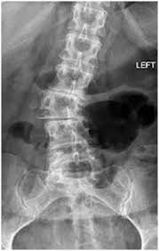 Adult Degenerative Scoliosis - Scoliosis Physiotherapy