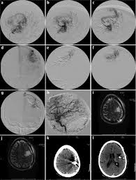The dilated vessels result in intestinal bleeding. Treatment Of Inoperable Cerebral Arteriovenous Malformations Neupsy Key