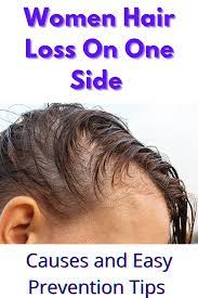 Women Hair Loss On One Side Causes And Easy Prevention Tips Hair Loss Women Hair Loss Natural Remedy Temple Hair Loss